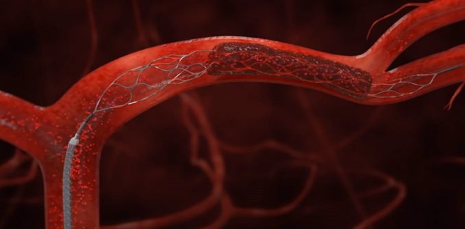 Mechanical Thrombectomy treatment in Gurgaon