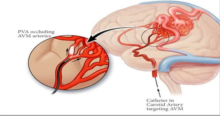 Carotid Angioplasty in Gurgaon